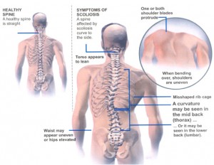 What-are-the-Symptoms-of-Scoliosis